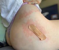 Noah Cyrus was bit by a spider and she posted a couple photos of it at the same time showing off her sexy ass in thong panties close up.